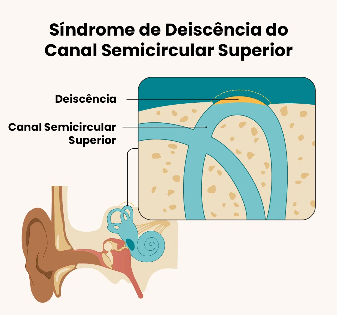 Síndrome de Deiscência do Canal Semicircular Superior