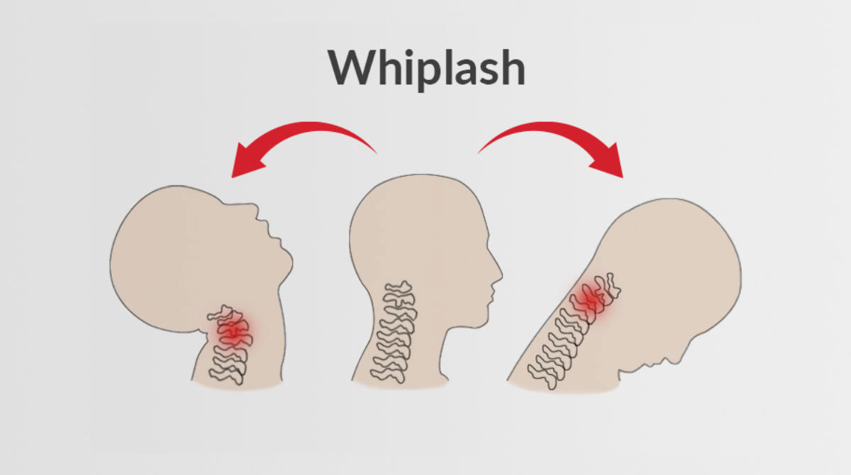 Tontura causada pelo pescoço: Whiplash ou efeito chicote