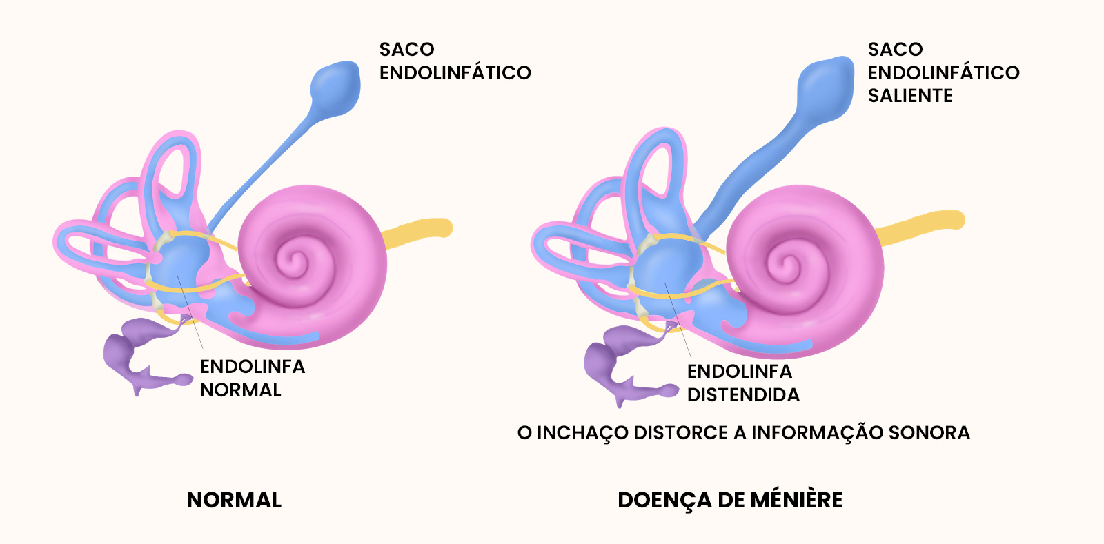 Doença de Ménière | Dra. Daniela Janolli