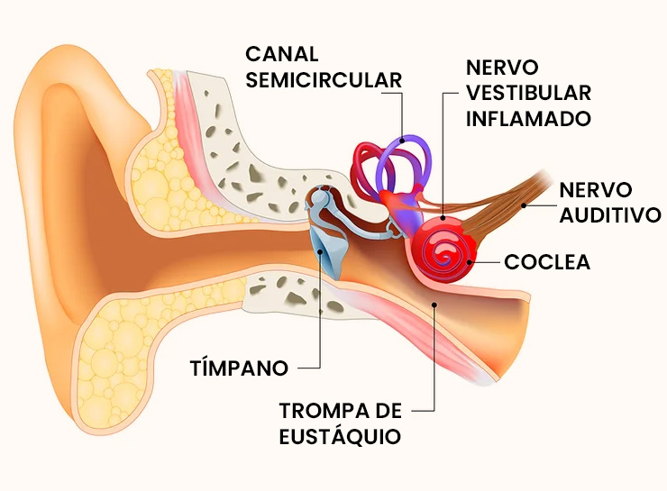 Neurite Vestibular | Dra. Daniela Janolli