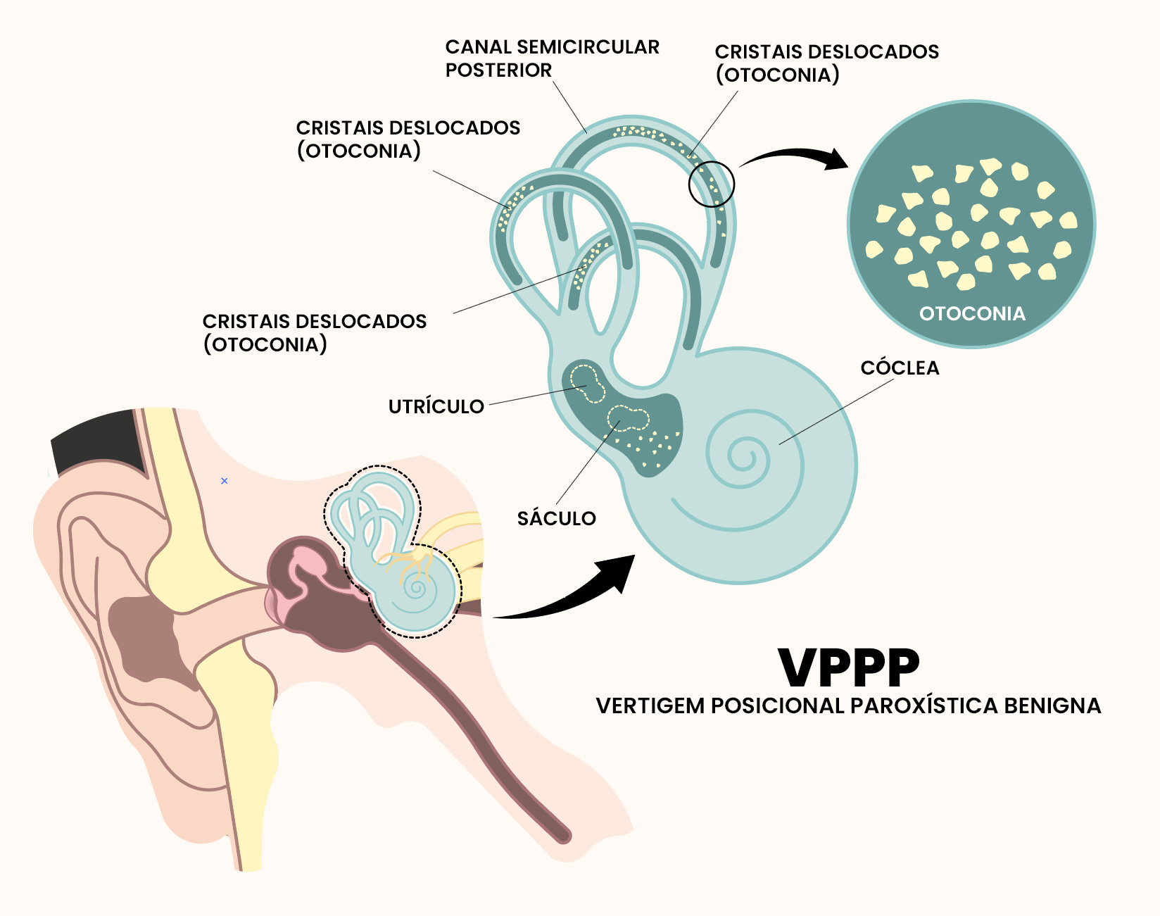 Vertigem Posicional Paroxística Benigna - VPPP | Dra. Daniela Janolli