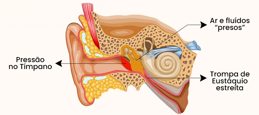 Ouvido fica entupido durante a decolagem ou aterrissagem de avião | Dra. Daniela Janolli
