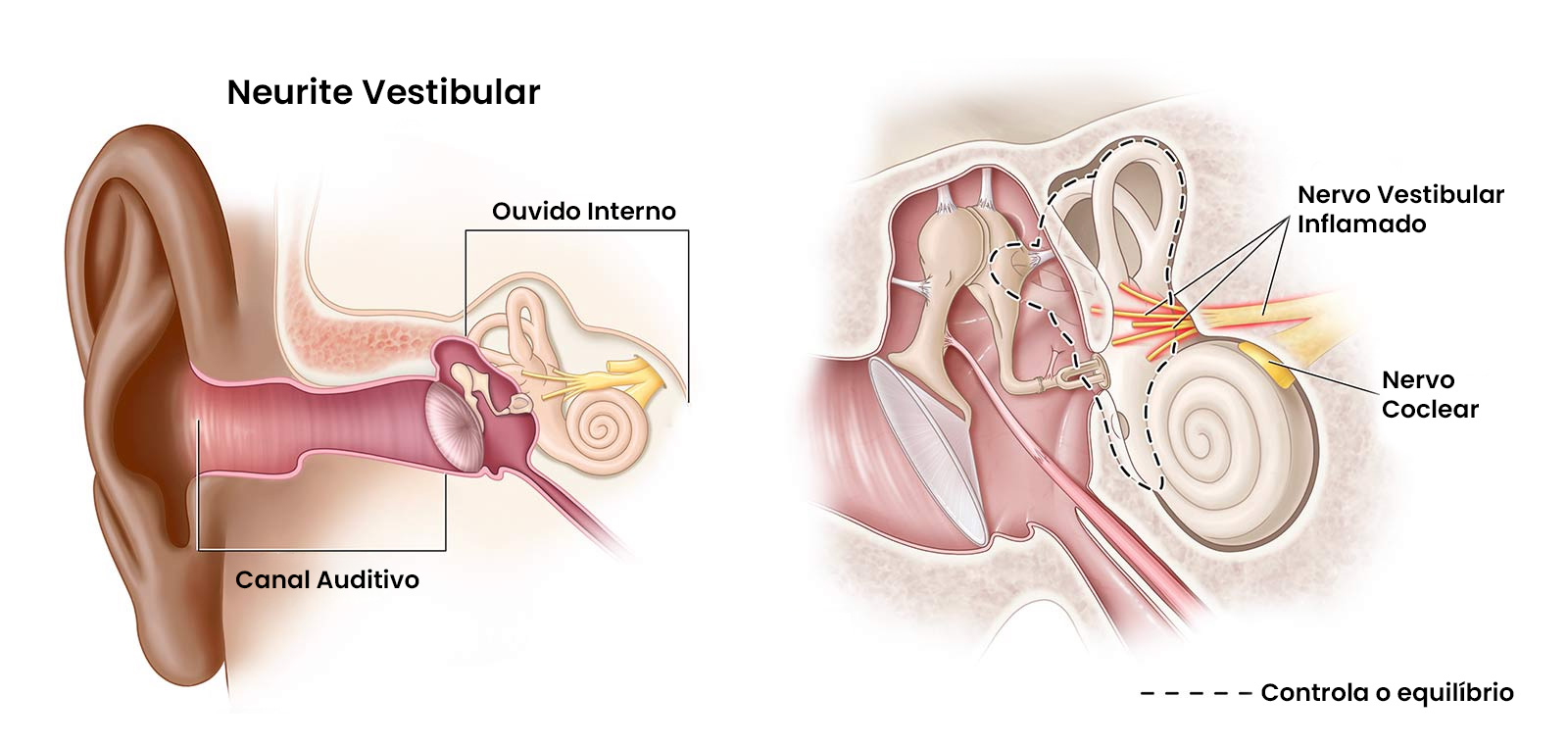 Neurite Vestibular | Dra. Daniela Janolli